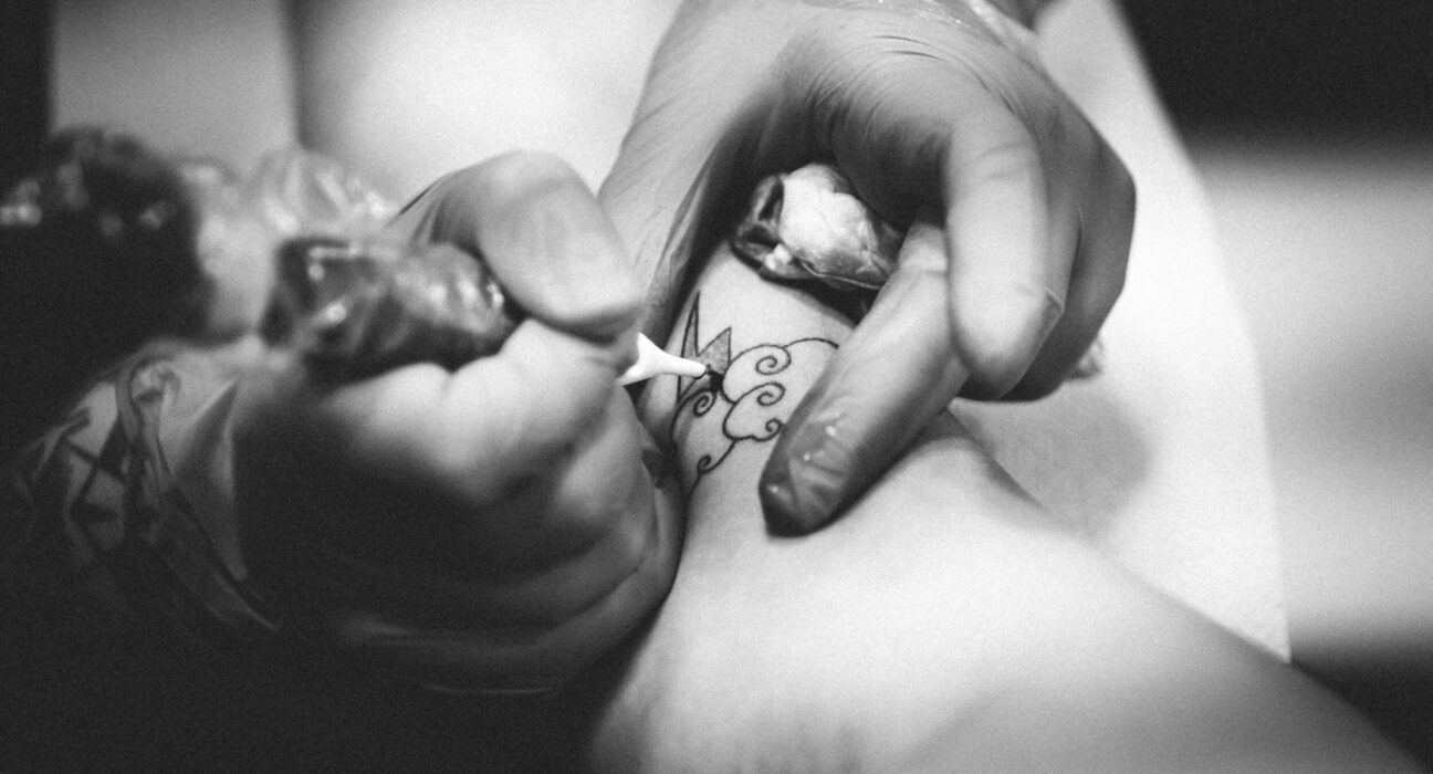 tattoo removal