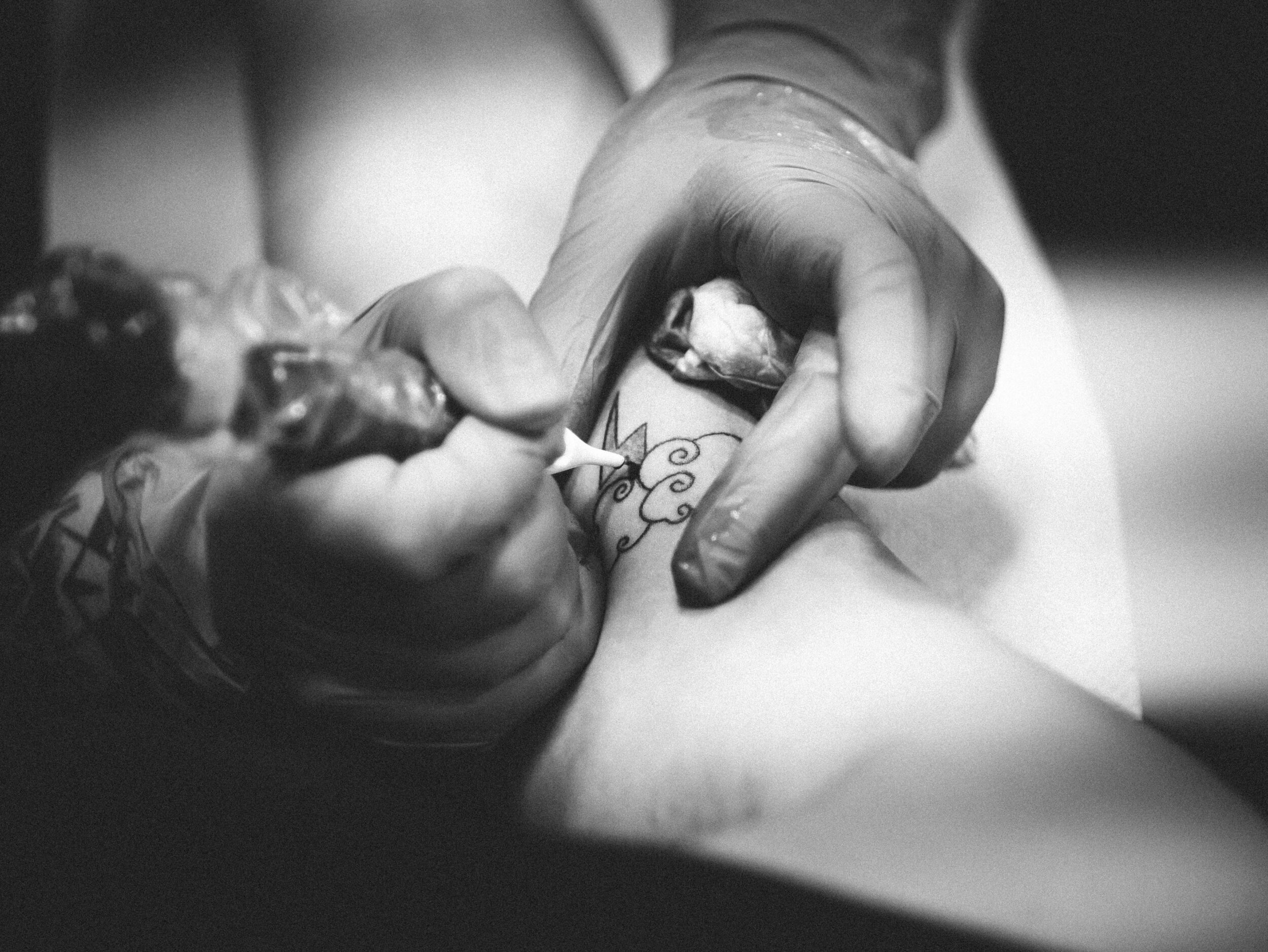 tattoo removal